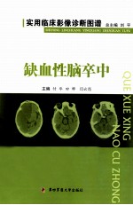 缺血性脑卒中 封面